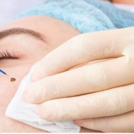 Mole and Warts Removal